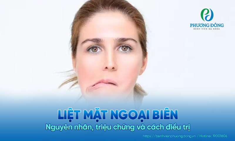 Liệt mặt ngoại biên: Nguyên nhân, triệu chứng và cách điều trị
