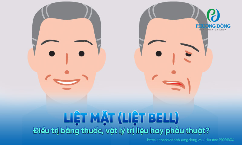 Liệt mặt (Liệt Bell): Điều trị bằng thuốc, vật lý trị liệu hay phẫu thuật?