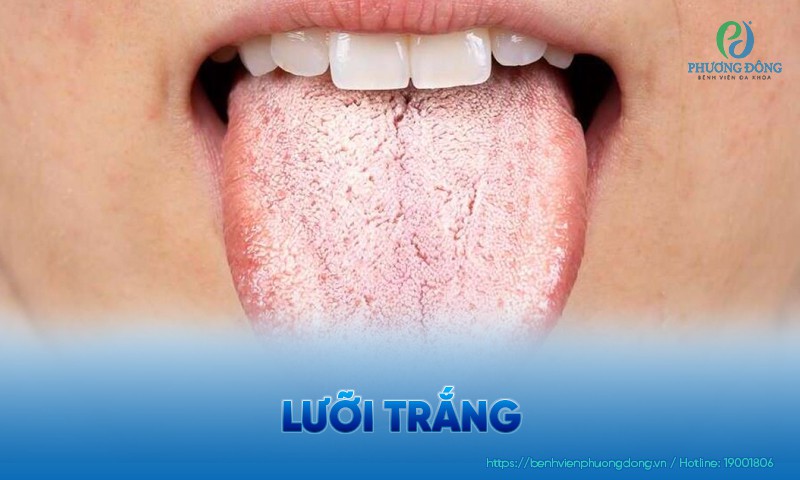Lưỡi trắng: Nguyên nhân, yếu tố nguy cơ và cách điều trị