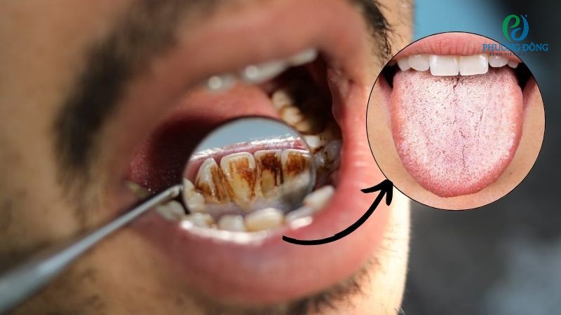 Những tác nhân gây lưỡi trắng bên cạnh chăm sóc vệ sinh răng miệng kém