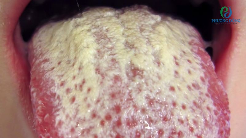 Nấm Candida phát triển quá mức trong khoang miệng gây trắng lưỡi