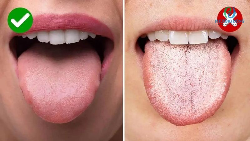 Lưỡi xuất hiện mảng bám trắng không nguy hiểm nếu do vệ sinh răng miệng kém