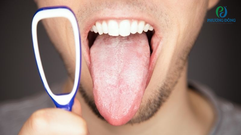 Hướng dẫn trị trắng lưỡi theo nguyên nhân gây bệnh