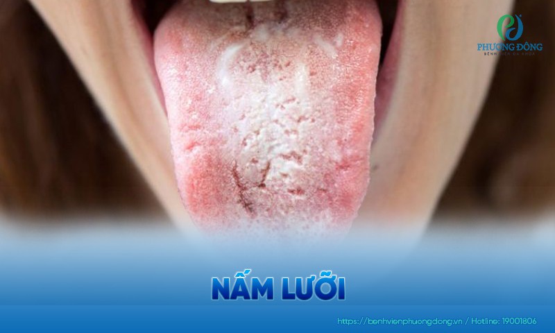 Nấm lưỡi: Triệu chứng, nguyên nhân và hướng điều trị