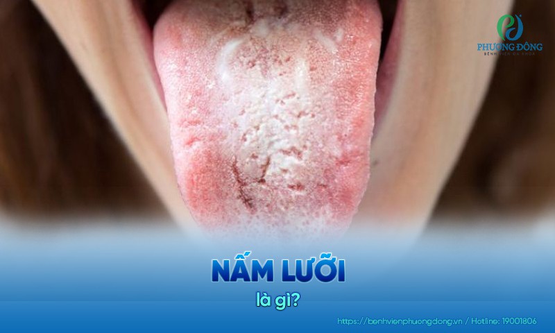 Nấm lưỡi là kết quả của sự phát triển quá mức của nấm Candida trong khoang miệng