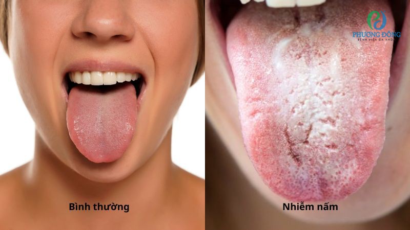 Hình ảnh so sánh lưỡi bình thường và lưỡi nhiễm nấm