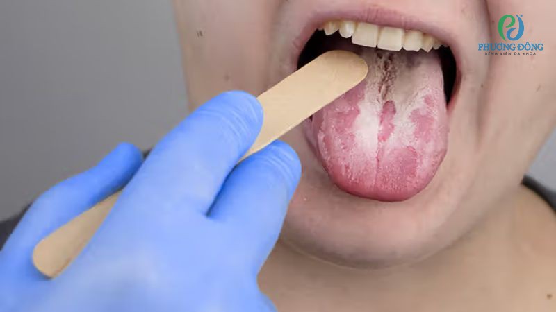 Các phương pháp chẩn đoán, xét nghiệm phát hiện nấm Candida