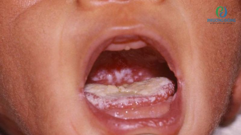 Hướng dẫn điều trị nấm lưỡi ở trẻ nhỏ