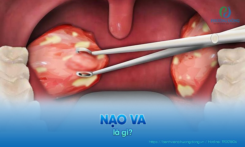 Nạo VA là phương pháp được chỉ định trong điều trị viêm amidan