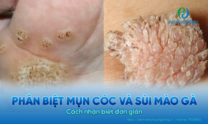 Phân biệt mụn cóc và sùi mào gà: Cách nhận biết đơn giản