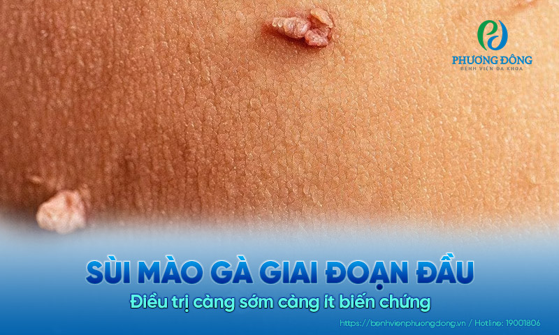 Sùi mào gà giai đoạn đầu: Điều trị càng sớm càng ít biến chứng