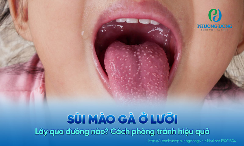 Sùi mào gà ở lưỡi lây qua đường nào? Cách phòng tránh hiệu quả
