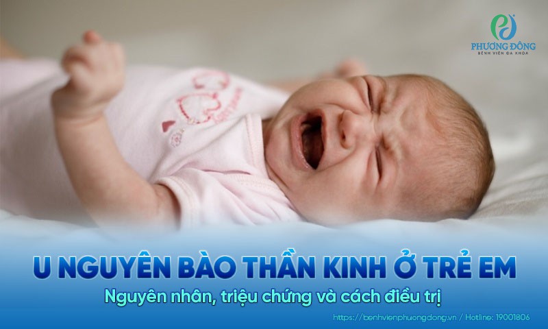 U nguyên bào thần kinh ở trẻ em: Nguyên nhân, dấu hiệu và cách điều trị