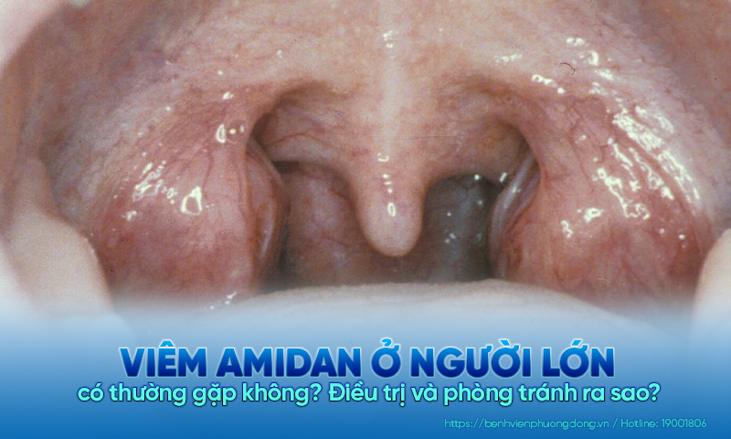 Viêm amidan ở người lớn là bệnh gì? Điều trị và phòng tránh ra sao?