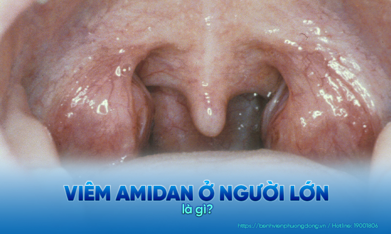 Viêm amidan ở người lớn là bệnh viêm nhiễm đường hô hấp