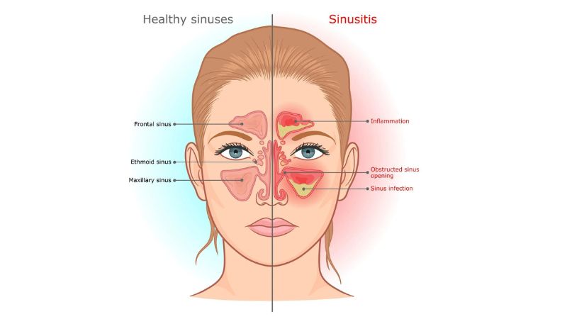 Viêm xoang là một trong các biến chứng gần của viêm amidan