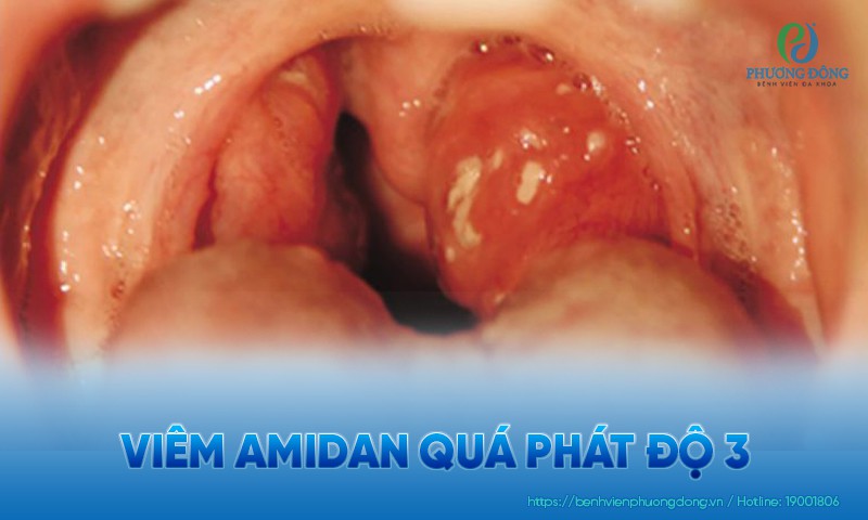 Viêm amidan quá phát độ 3: Triệu chứng, nguyên nhân và biến chứng
