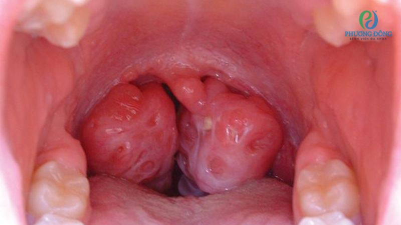 Các nhóm biến chứng khi amidan quá phát độ 3 không được can thiệp kịp thời