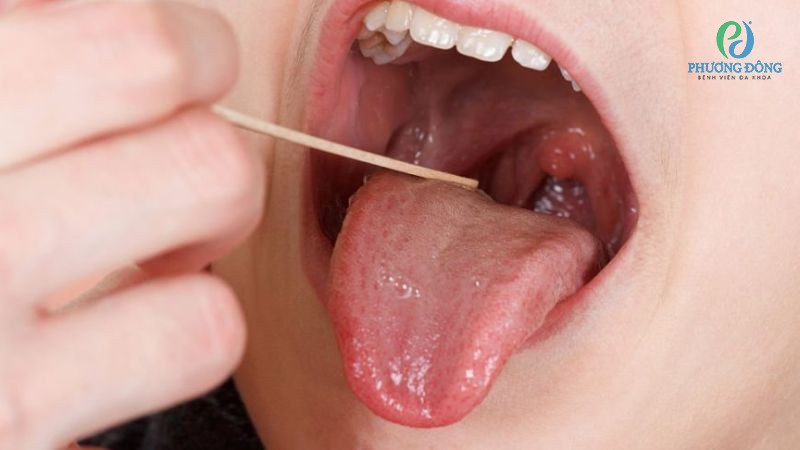 Một số lưu ý trong điều trị amidan quá phát độ 3