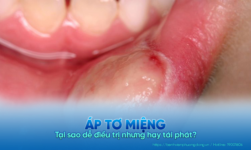Tại sao áp tơ miệng dễ điều trị nhưng hay tái phát?