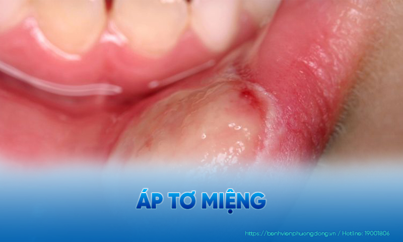 Viêm miệng áp tơ là tình trạng miệng xuất hiện nhiều vết loét hình bầu dục
