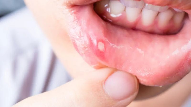 Một số vết loét có thể xảy ra khi bạn cắn vào má