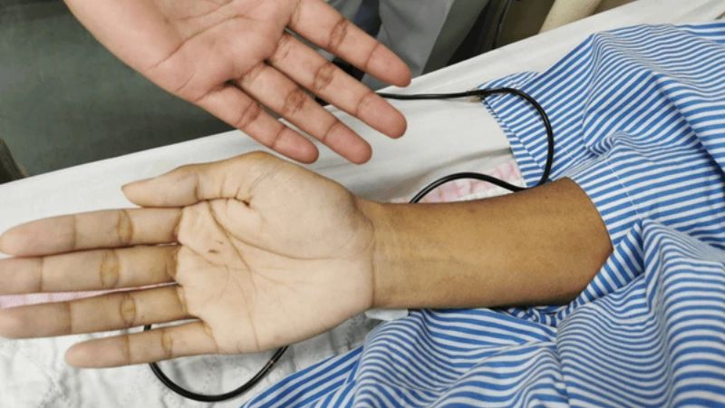 Người bị thiếu máu có nguy cơ loét miệng cao gấp nhiều lần người bình thường