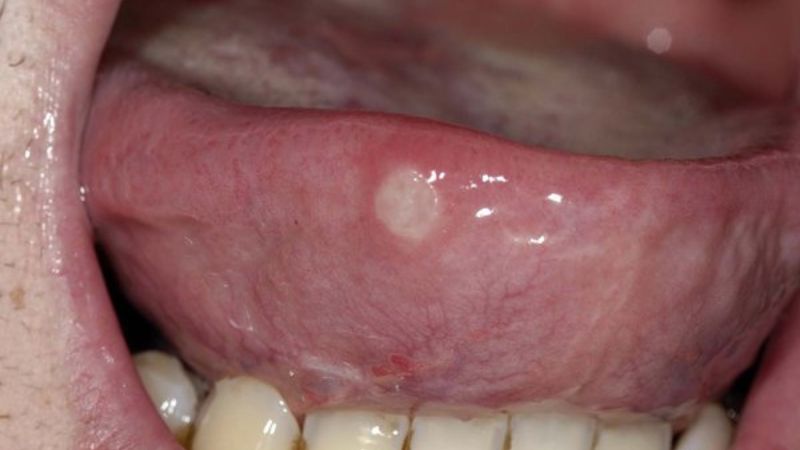 Các nốt loét miệng nhỏ thường xuất hiện ở môi, má, lưỡi
