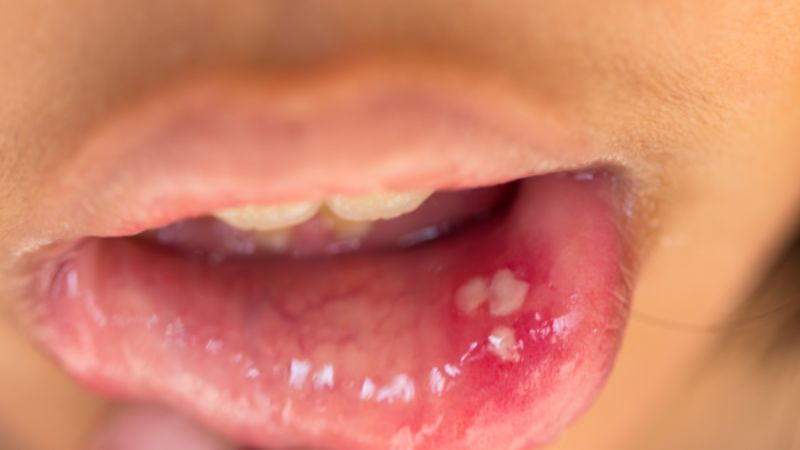 Bé bị áp tơ miệng với các nốt loét lớn