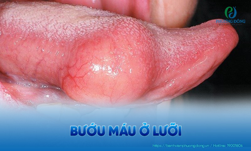 Bướu máu ở lưỡi: Triệu chứng, nguyên nhân và cách điều trị