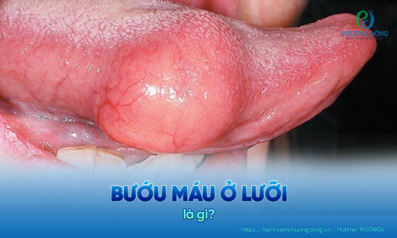 Bướu máu ở lưỡi là tình trạng xuất hiện u máu trên bề mặt lưỡi