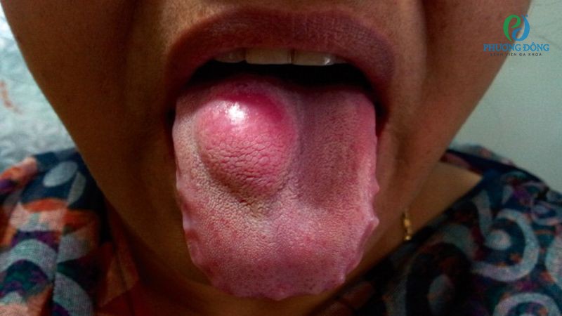 Có nhiều yếu tố được dự đoán là nguyên nhân gây nên cục bướu ở lưỡi
