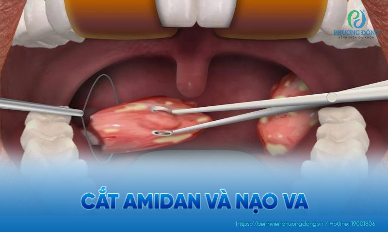 Cắt amidan và nạo VA: Chỉ định và quy trình kỹ thuật