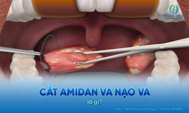 Cắt amidan và nạo VA là kỹ thuật loại bỏ các ổ viêm nhiễm tái phát nhiều lần