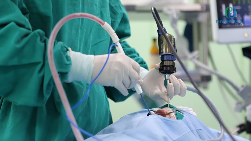 Quy trình kỹ thuật phẫu thuật amidan và VA