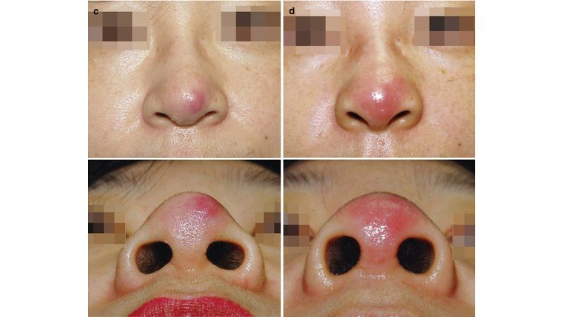 Đầu mũi sưng đỏ, bóng nhẵn là dấu hiệu bất thường sau phẫu thuật
