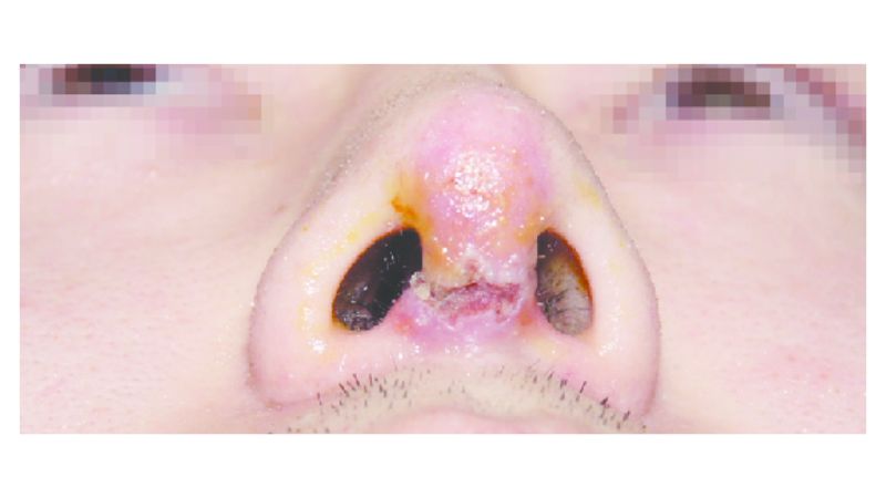 Nếu không chăm sóc cẩn thận, bạn có thể bị nhiễm trùng vết mổ