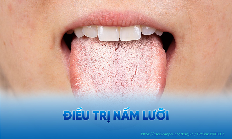 Điều trị nấm lưỡi phải được thực hiện đúng lúc, kịp thời