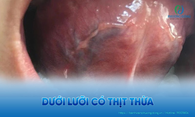 Dưới lưỡi có thịt thừa do đâu? Các hướng can thiệp điều trị