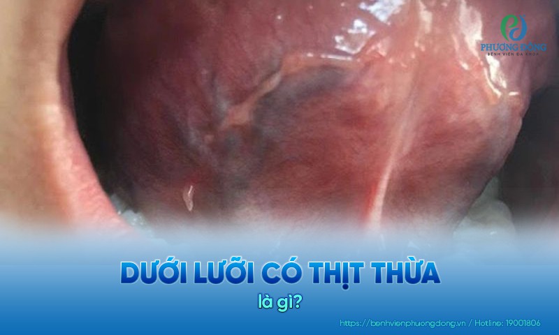 Dưới lưỡi có thịt thừa là tình trạng xuất hiện các nốt mụn, u nhú bên dưới lưỡ