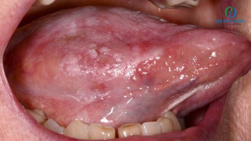 Lưỡi có sợi thịt thừa cảnh bào ung thư khoang miệng