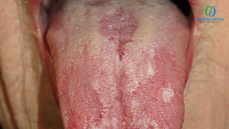 Viêm lưỡi về lâu dài có thể hình thành các cục thịt thừa
