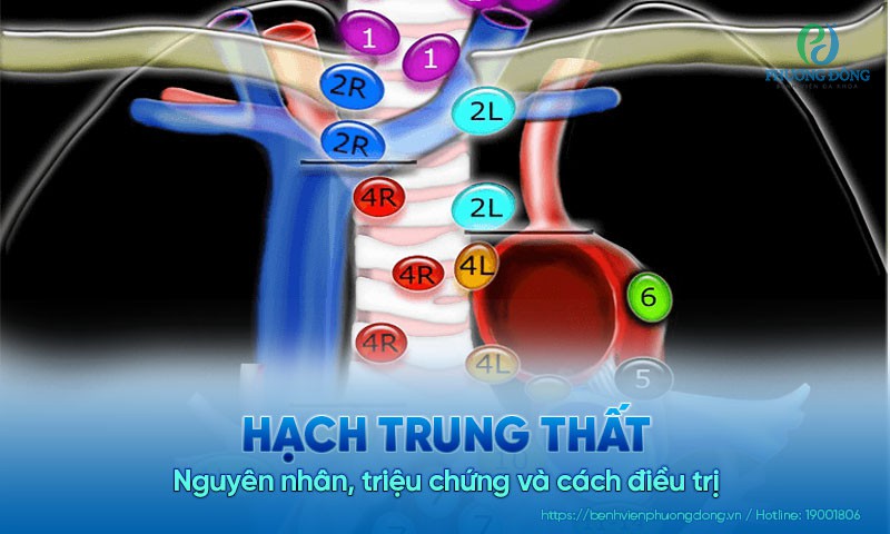 Hạch trung thất: Nguyên nhân, triệu chứng và cách điều trị