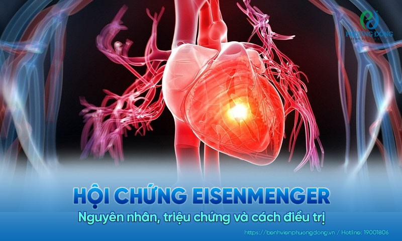 Hội chứng Eisenmenger: Nguyên nhân, triệu chứng và cách điều trị