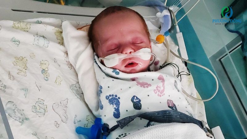 Nhóm đối tượng thường được chỉ định tiêm Palivizumab trước mùa RSV bắt đầu