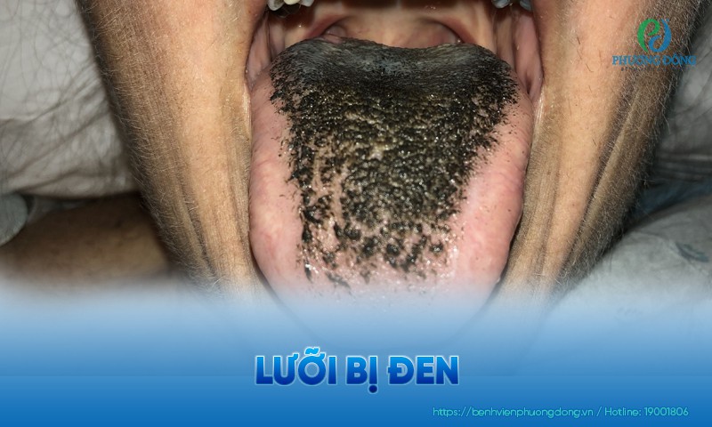 Lưỡi bị đen: Triệu chứng, nguyên nhân và hướng điều trị