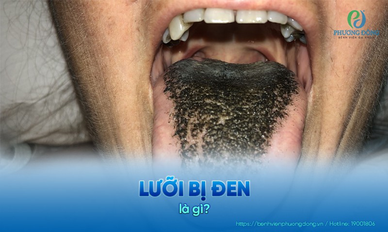 Lưỡi bị đen vừa là tình trạng sức khỏe bình thường, vừa cảnh báo bệnh lý liên quan