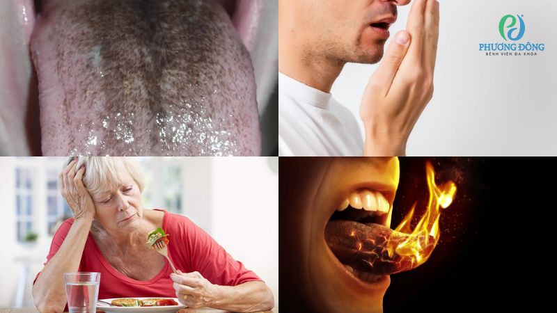 Triệu chứng nhận biết lưỡi nổi đốm đen cần thăm khám