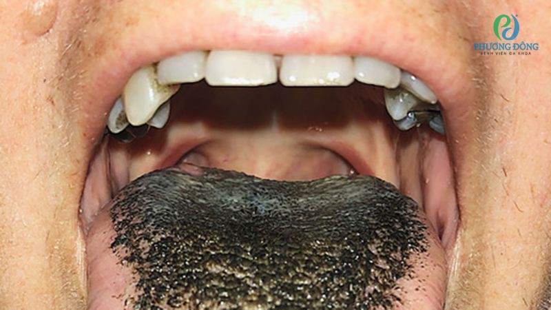 Điều trị lưỡi chuyển màu đen phụ thuộc phần lớn vào nguyên nhân