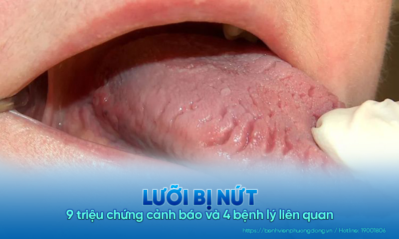 9 triệu chứng cảnh báo lưỡi bị nứt và 4 bệnh lý liên quan